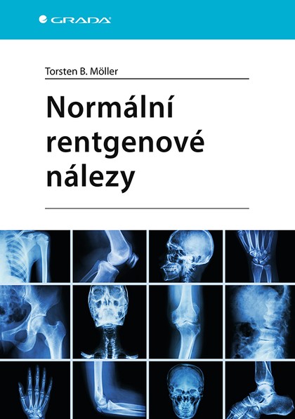 E-kniha Normální rentgenové nálezy - Torsten B. Möller